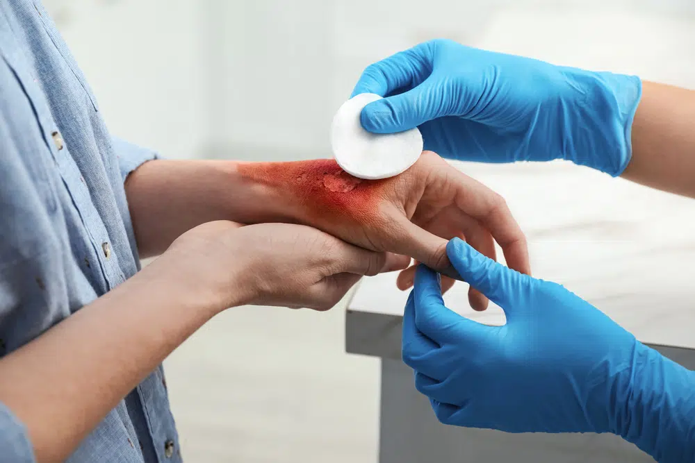 Dovtor Treating Burn Injury Photo of Burn Injury
